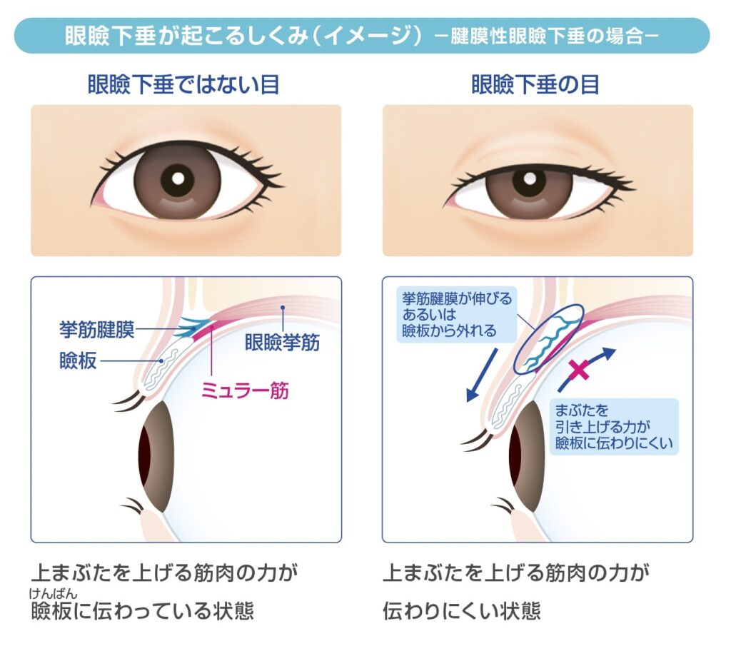 眼瞼下垂が起こるイメージ